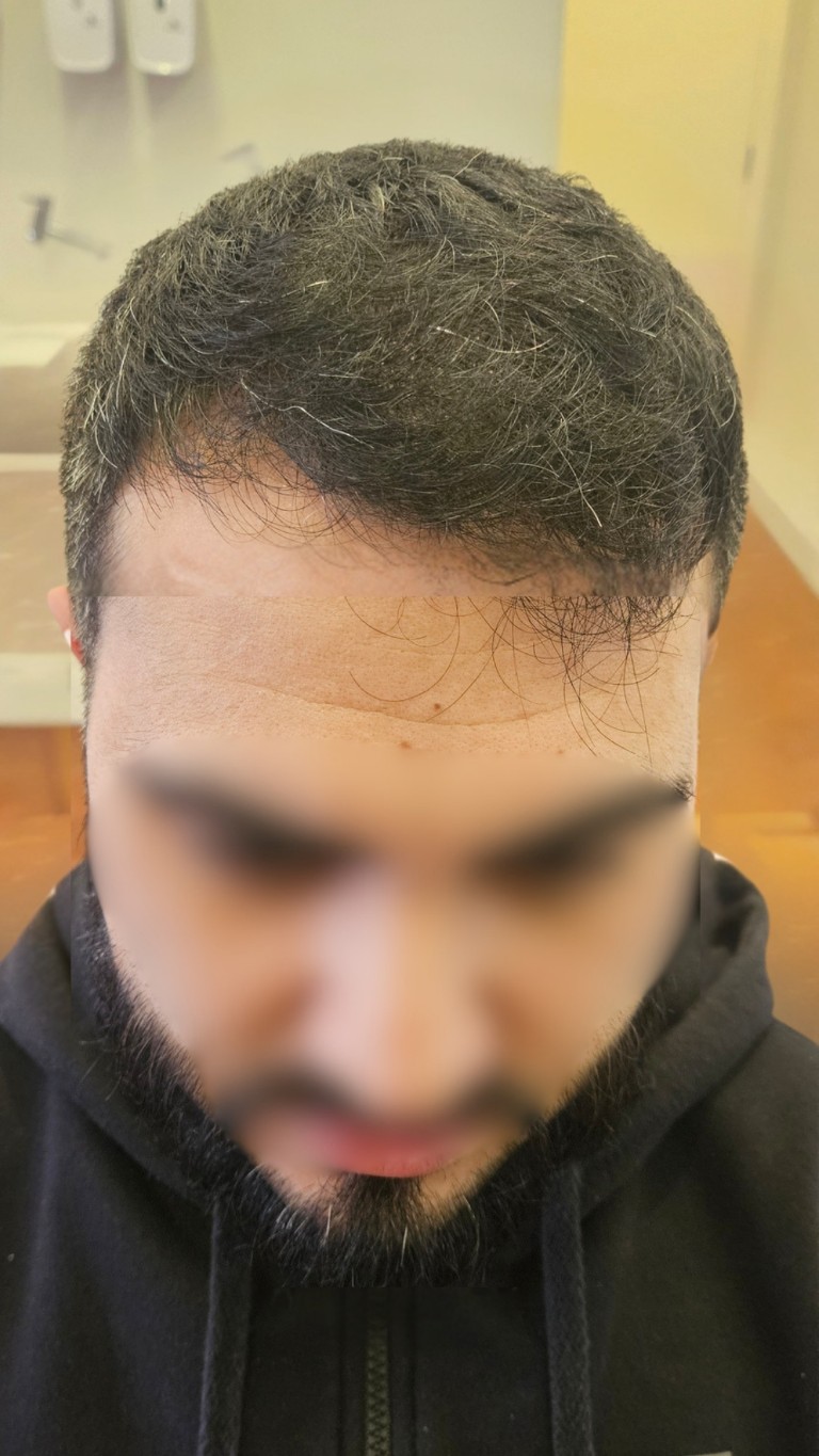 Paciente depois do transplante — caso 2
